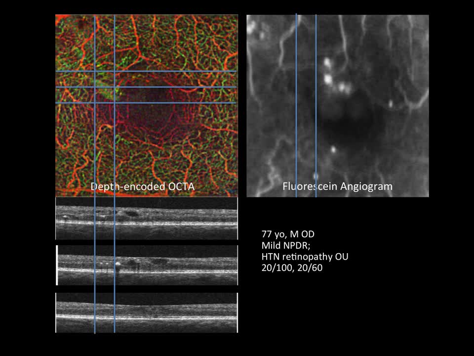 OCTA may enable characterization of new type of intraretinal fluid in DR patients