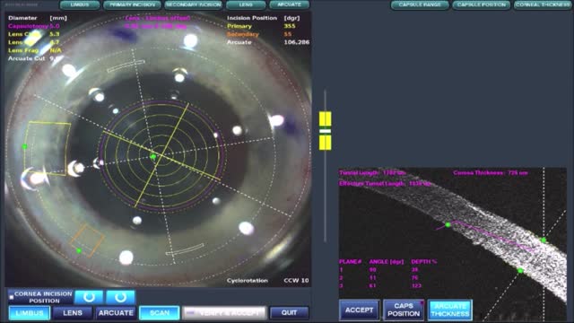 Using Astigmatic Keratotomy with LenSx for Laser Assisted Cataract Surgery with a Toric IOL