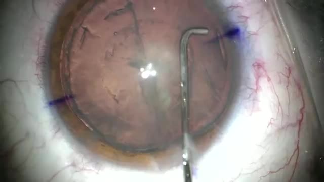 Hydrodissection and Hydrodelineation in Patient with Megalocornea