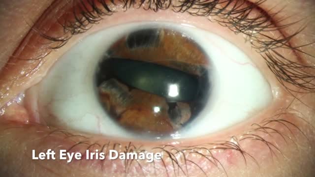 Bright Ocular Implant Damage Repaired with Human Optics Artificial Iris