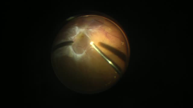 Diabetic Tractional Retinal Detachment
