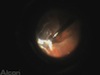 Double Globe Perforation during Retrobulbar Anesthesia