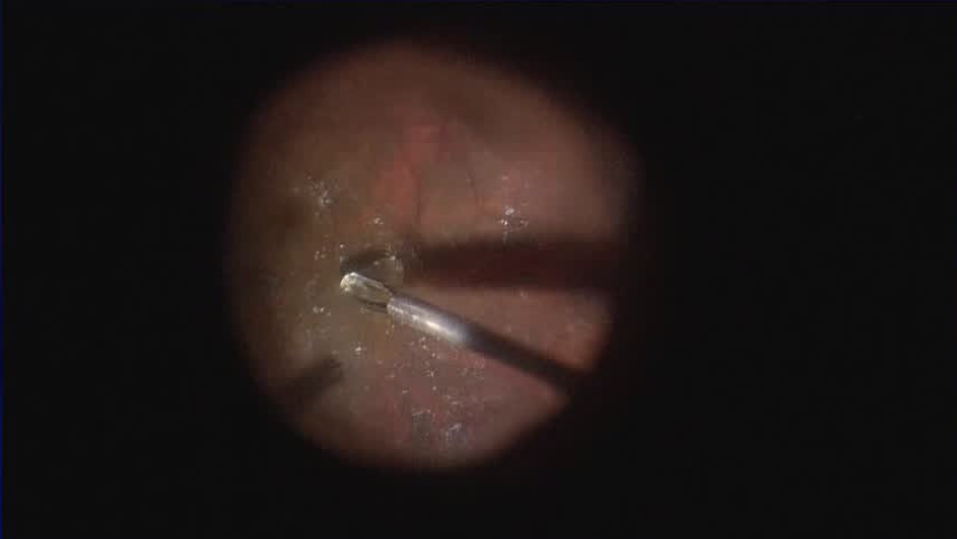Macular Hole