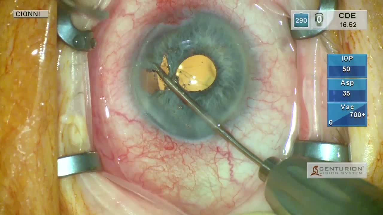 Coloboma Repair