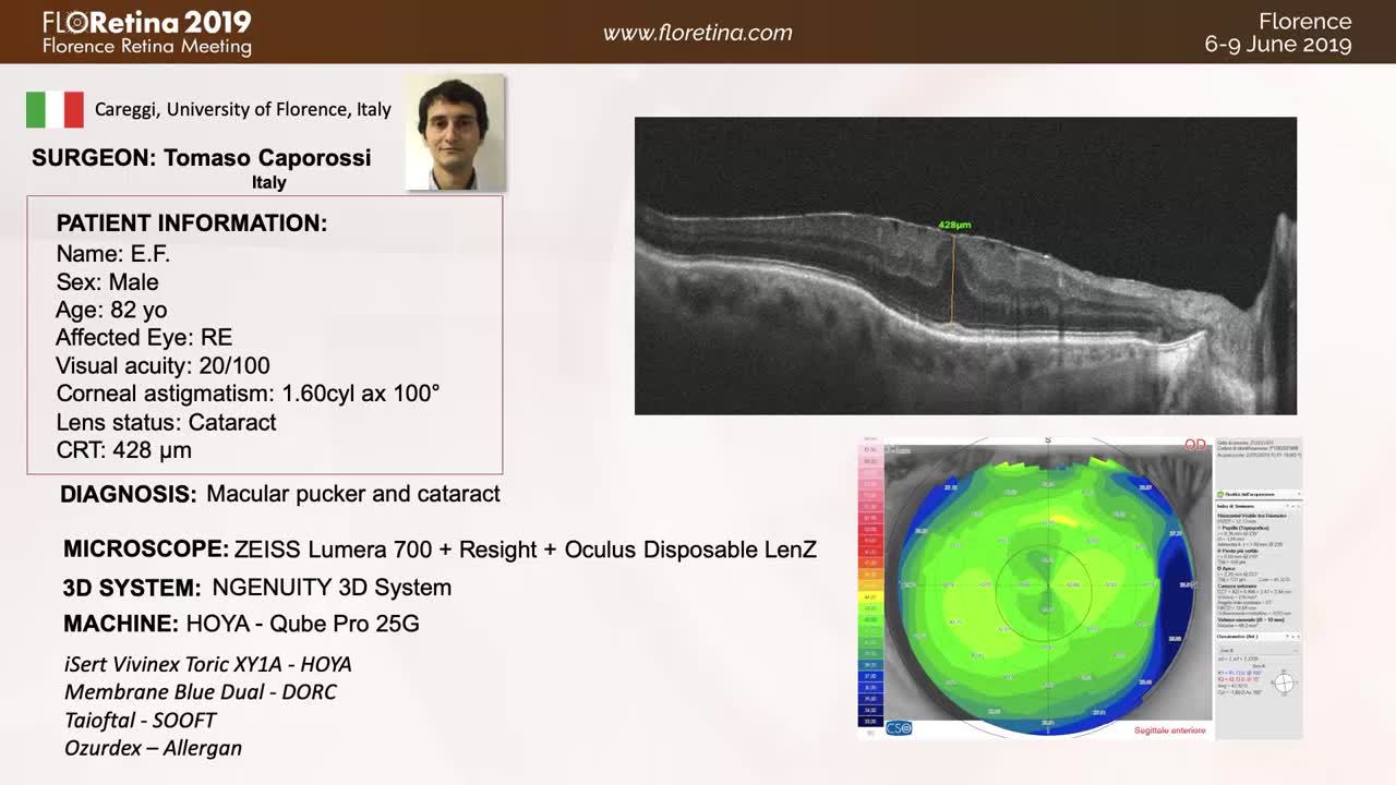 [3D] Phacovitrectomy With Astigmatism Correction