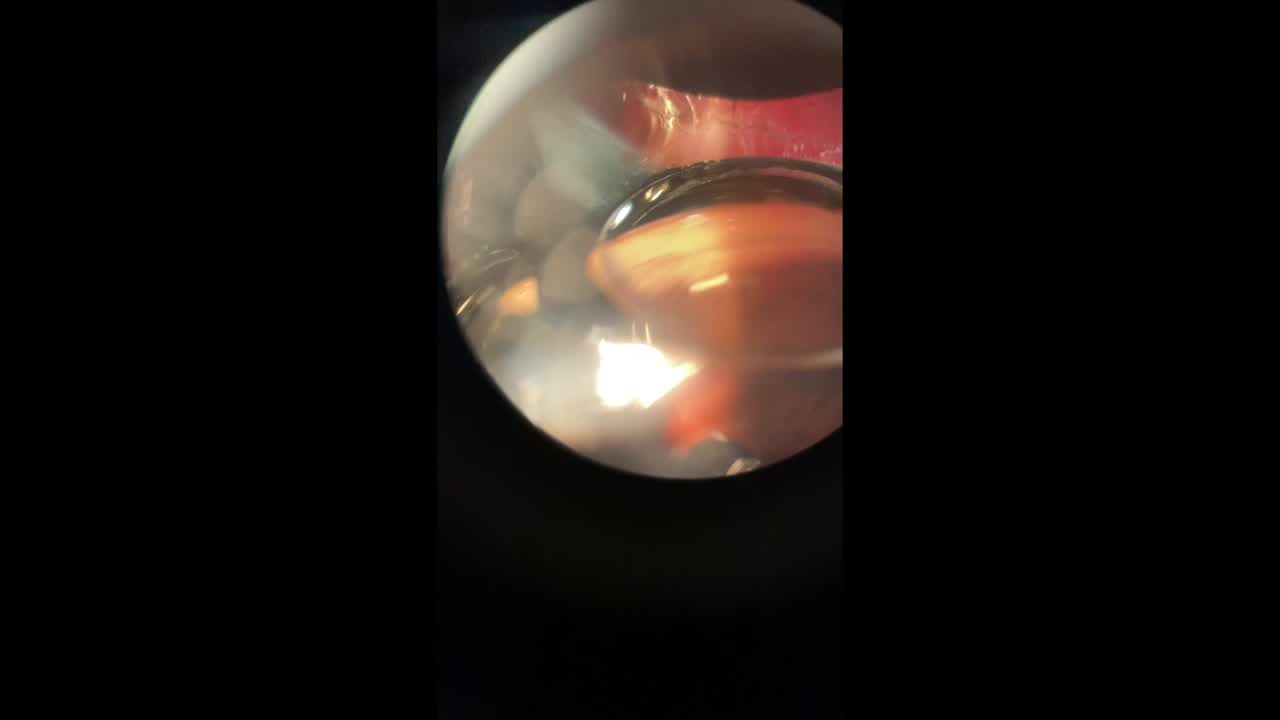 Durysta in the Supine Position