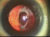 Difficult Cases - Dislocated Lens with Phimosis