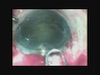 Modified Surgical Technique of Combined Manual SICS and Trabeculectomy
