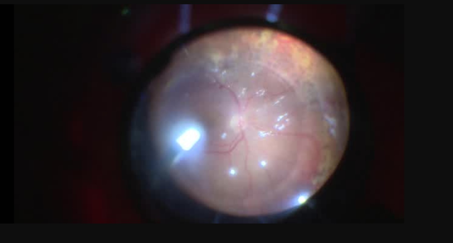 [3-D] Techniques for Managing Recurrent Retinal Detachment