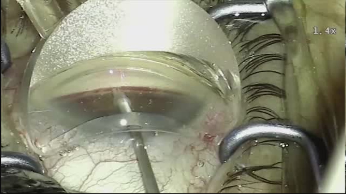 Glaukos iStent Inject [3-D]