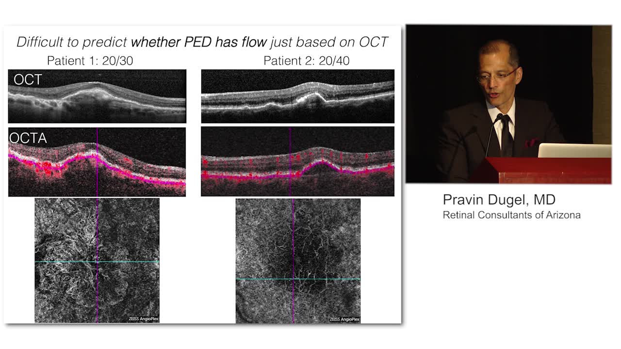 CNV Visualization on OCT-A May Inform Treat-and-Extend Decisions