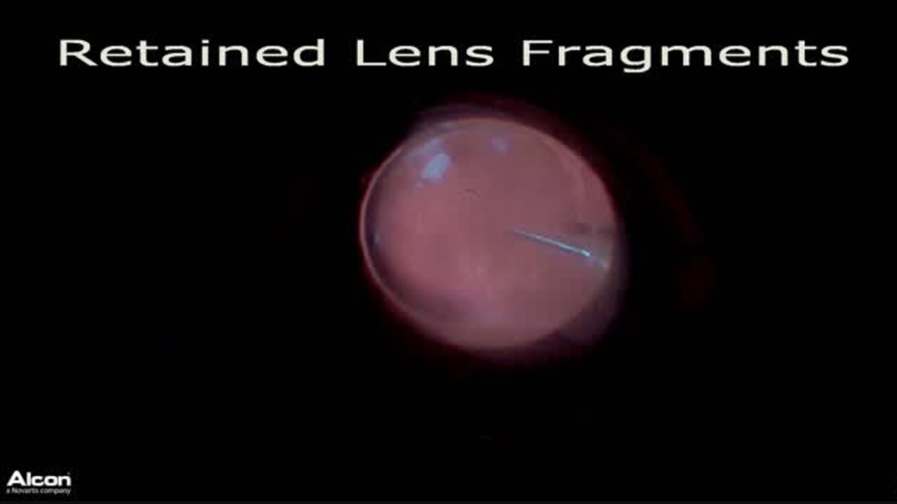 Retained Lens Fragments