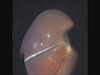 25 G Vitrectomy for the Treatment of Total Bullous Rhegmatogenous Retinal Detachment