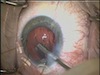 Successful Traumatic Cataract Extraction