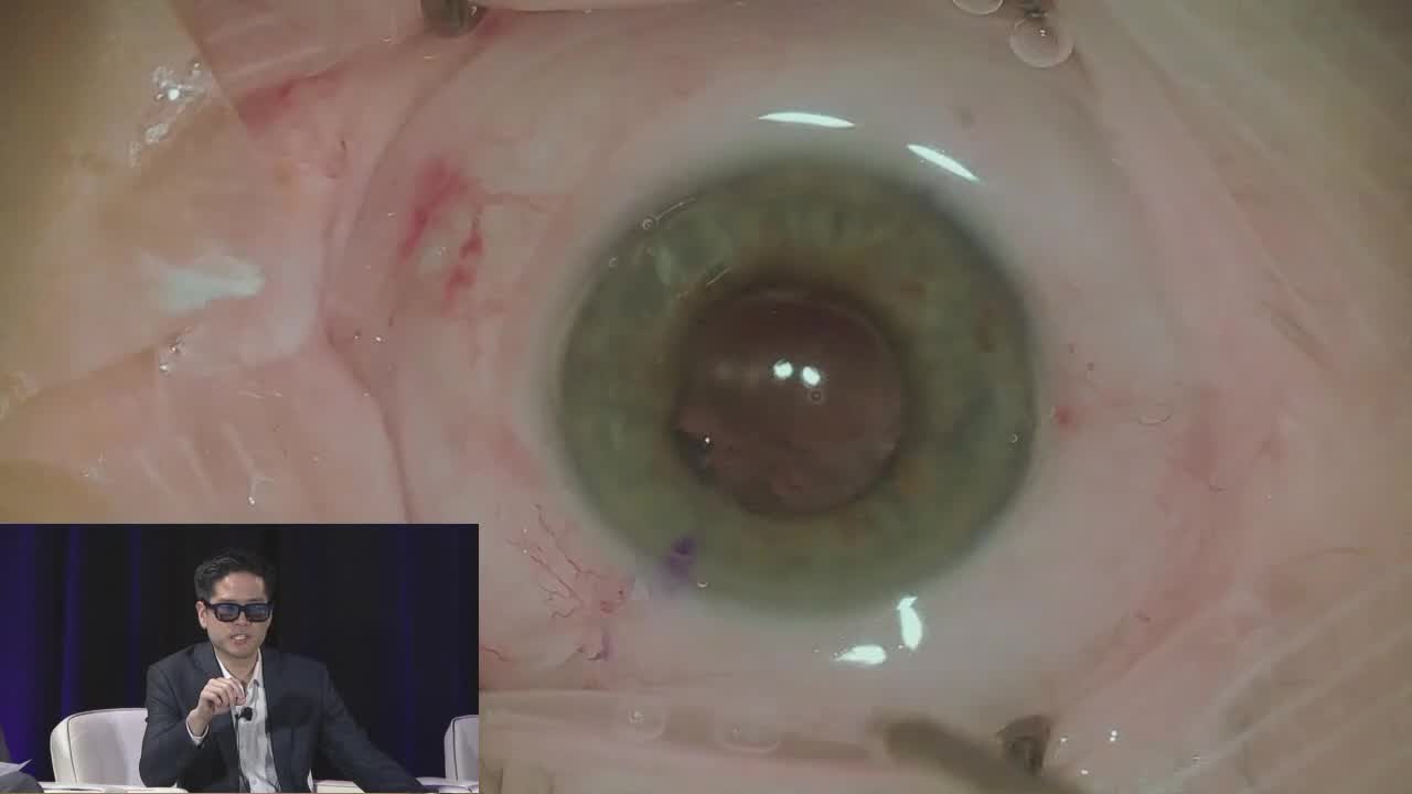 3-Port Sutureless Intrascleral Surgery; 27g