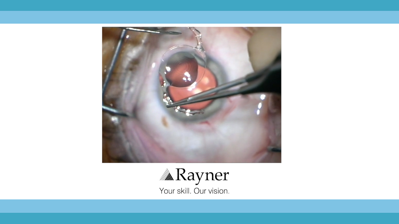 The World's First Sulcoflex Trifocal Pseudophakic IOL Implantation