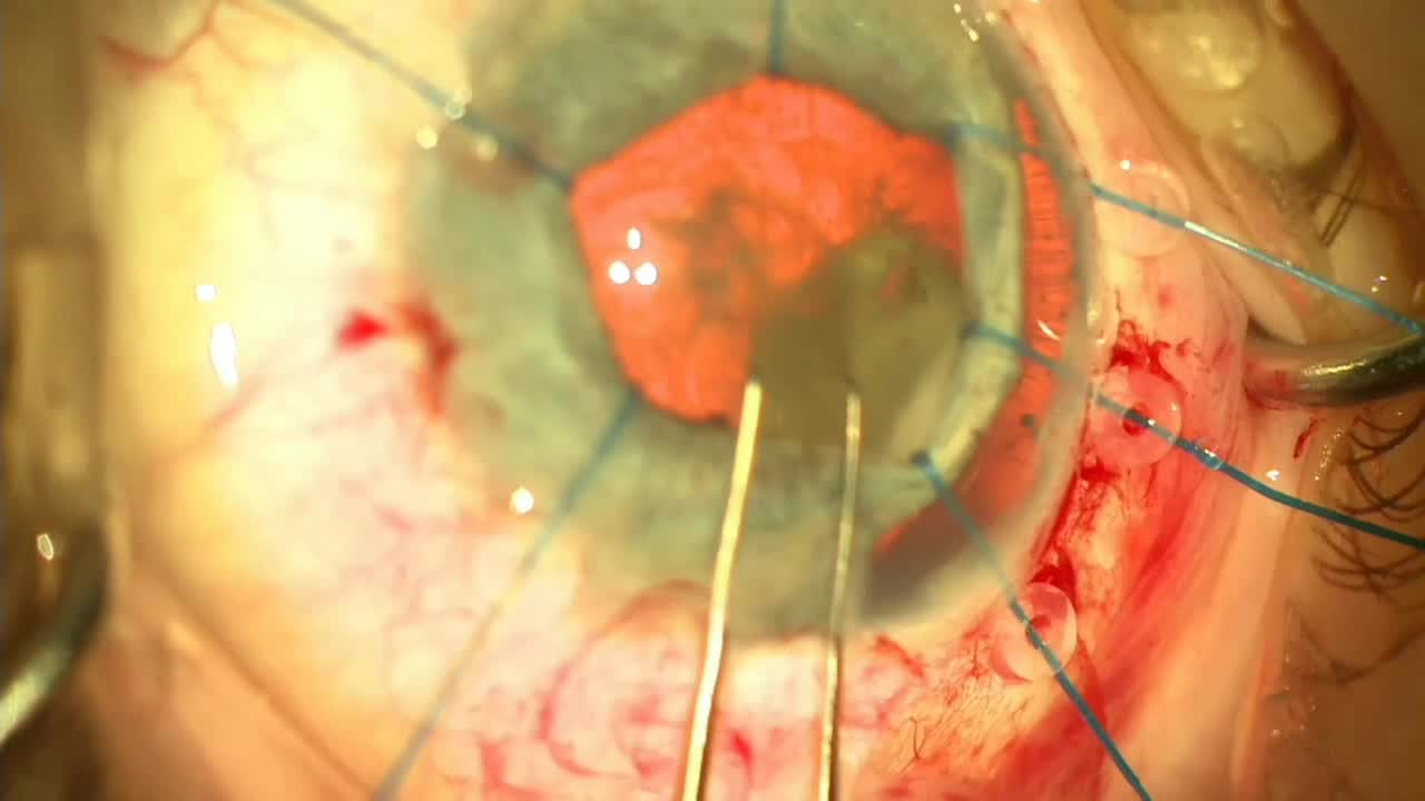 Traumatic Cataract With Iridodialysis
