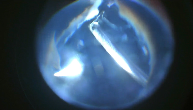 An Unexpected Retinal Problem in Persistent Fetal Vasculature