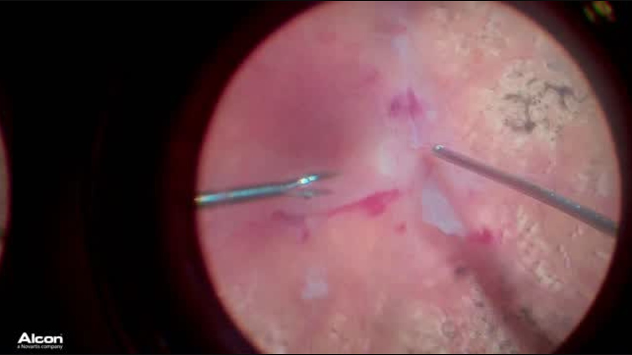 Bimanual Repair of TRD