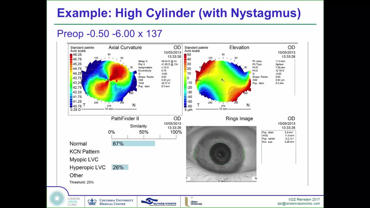 SMILE with Nystagmus