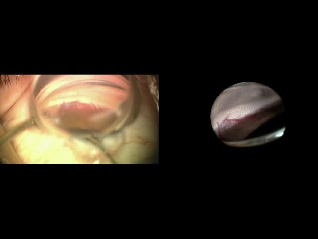 Endoscopic View of Trab360