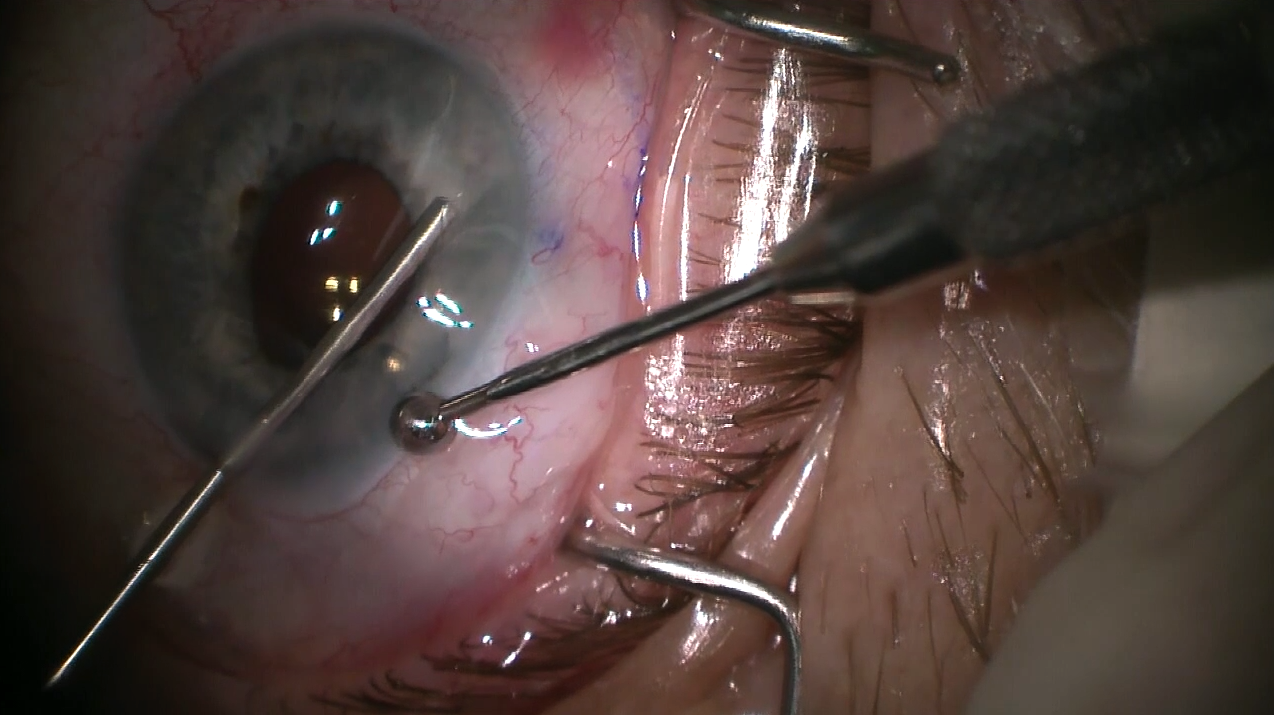 Xen45 Implant Procedure