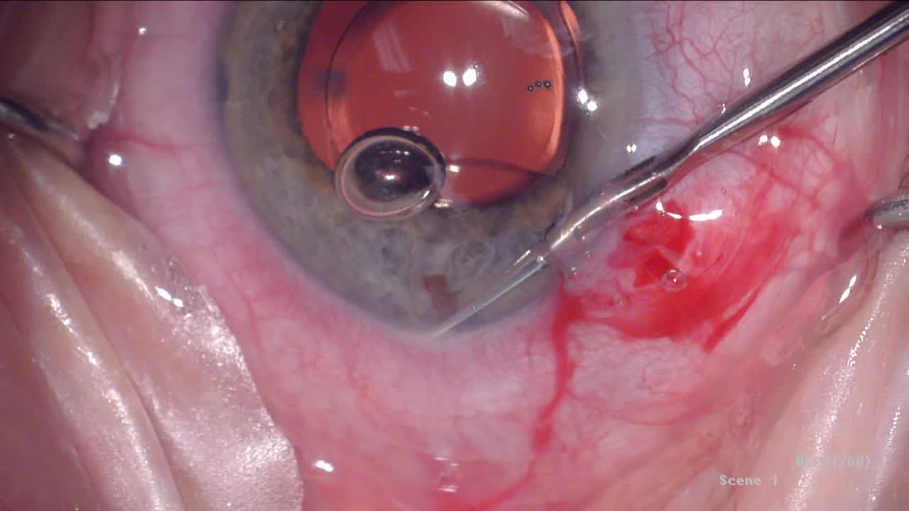 CyPass Micro-Stent Trimming Technique 