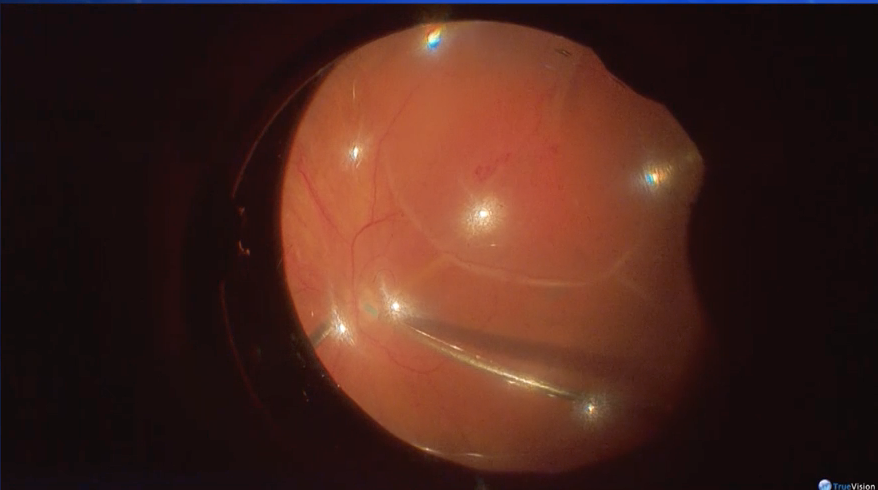 Macular Fold & PVR