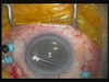 Supra-Choroidal Infusion with 25G and 27G System