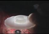 Placement of AcrySof IOL
