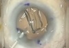 Implantation of a Tecnis Toric IOL