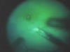 Green Light Assisted ILM Peeling in Macular Hole Surgery