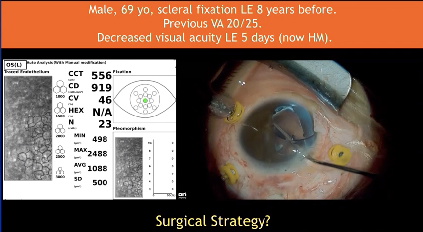 Subluxated IOL