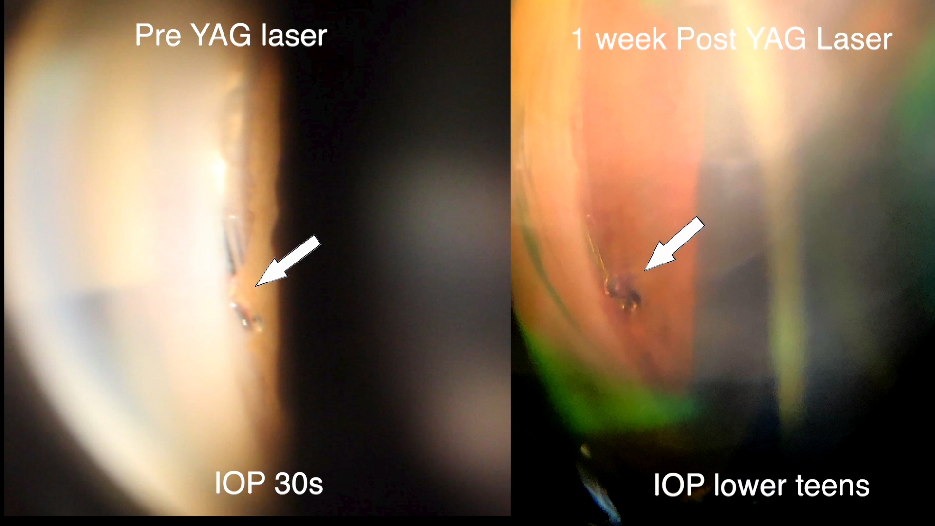 Fresh Insights Into Scaffolding Schlemm Canal