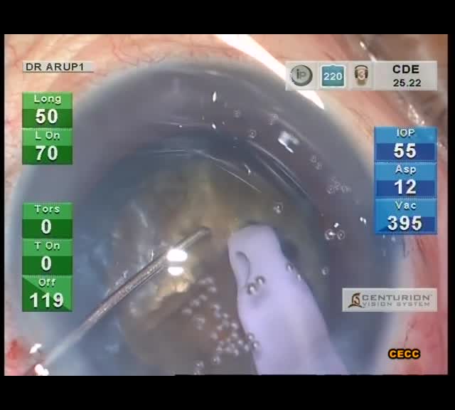Chop Technique for Hard Cataracts