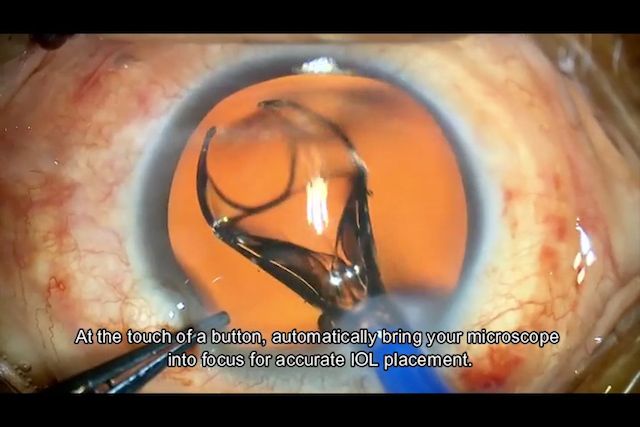 Importance of a Good Red Reflex in Combined Retina Surgeries, Proveo 8