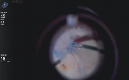 Vitrectomy Using 25-Gauge DSP ILM Forceps