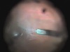 Surgery for Chronic Macular Hole