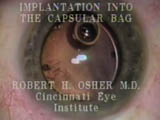 Implantation into the Capsular Bag