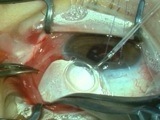Supra Tenons Placement of Molteno3