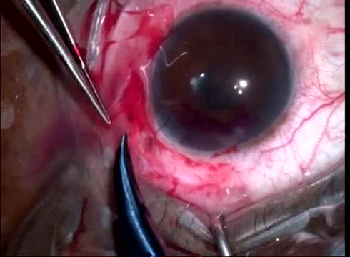 Iridodialysis Repair Using a Hand-back Technique