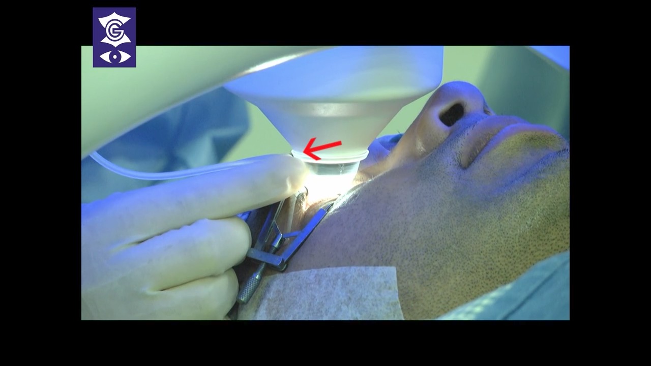 Compensating for Cyclotorsion in SMILE Astigmatism Treatments