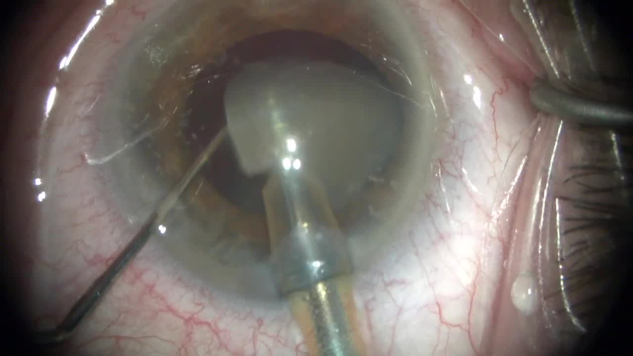 Mature cataract using AMO Signature Pro