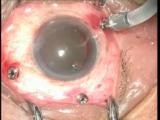 Post-Lucentis SRVNV removal 23 gauge