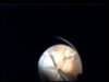 Vitreoretinal Surgery for Tractional Retinal Detachments Due to PDR