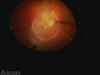 Giant Retinal Tear Retinal Detachment