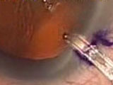 A Scare during Cataract Surgery