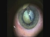 Intumescentive cataract with XFS and Small Pupil