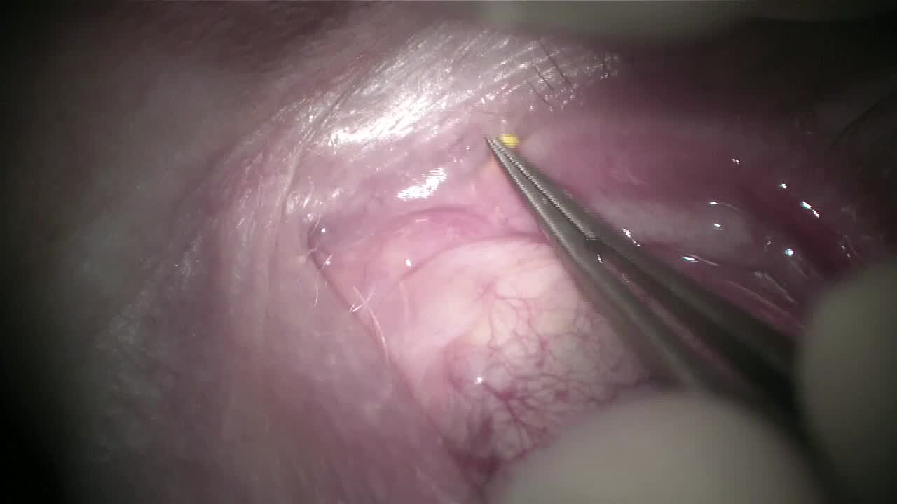 Dextenza Wet Insertion