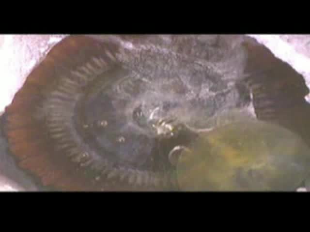 Amputation of Vitreous During Anterior Vitrectomy